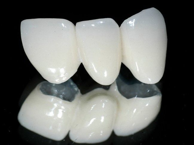 Răng sứ kim loại thường